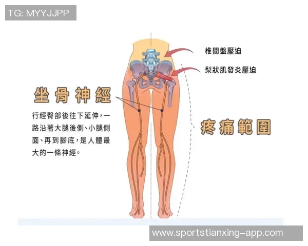 专家解读坐骨神经痛成因及治疗方法大多数患者可避免手术治疗 专家解读坐骨神经痛成因及治疗方法大多数患者可避免手术治疗